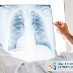 Ung thư phổi