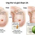 Các phương pháp chữa bệnh ung thư hiện nay